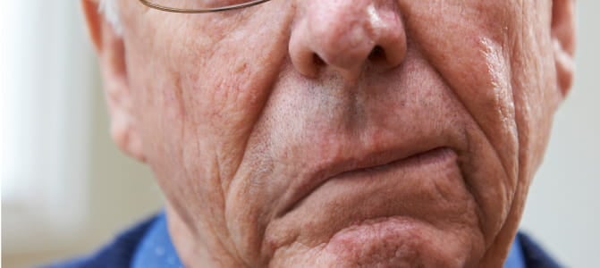 Signe d'AVC : illustration d'un visage avec un côté affaissé.