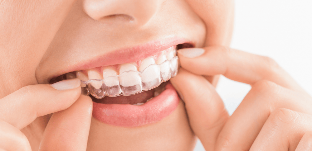 invisalign banner