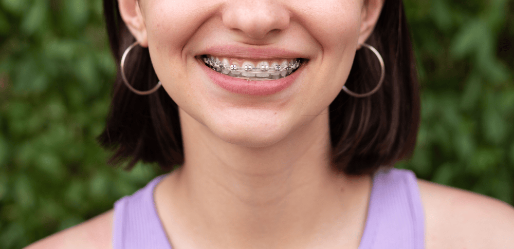 Teeth straightening options