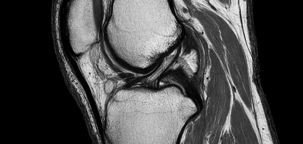 IRM genou diagnostic douleur genou