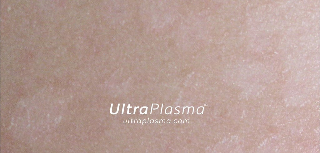 ultraplasma.com_Tinea_Versicolor_treatment_tinea_mantar_tedavi_ultrap_plasma_ultra_plazma