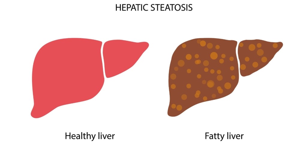 Comparison of healthy liver vs. fatty liver showing fat accumulation from carbohydrates.
