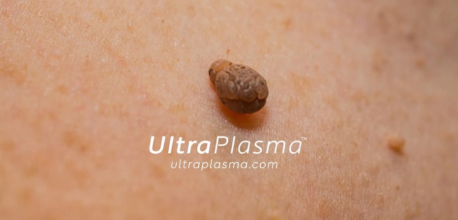 ultraplasma.com_skin_tag_removal_treatment_et_beni_temizleme_silme_tedavi_ultra_plasma_ultra_plazma