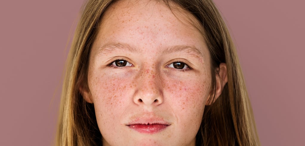 using salicylic acid for treating acne