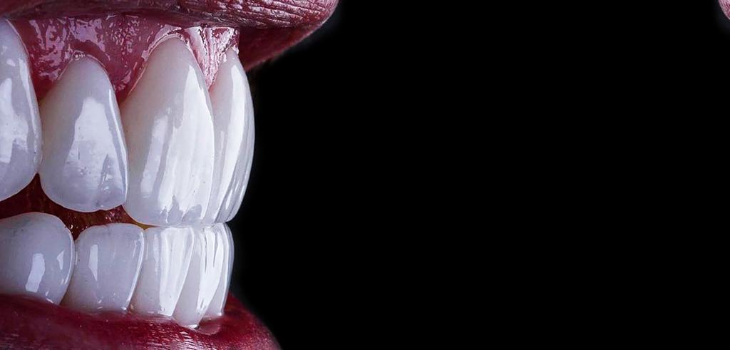 Close-up of white cosmetic dental veneers and porcelain crowns on a patient's straight teeth.