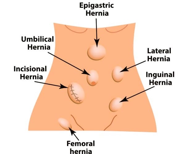 Hernia