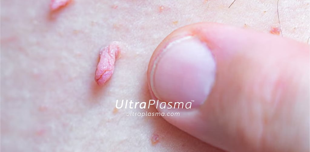 ultraplasma.com_skin_tag_removal_treatment_et_beni_temizleme_silme_tedavi_ultra_plasma_ultra_plazma2