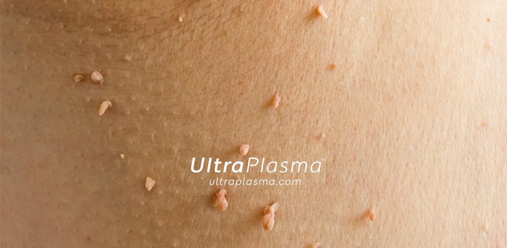 ultraplasma.com_skin_tag_removal_treatment_et_beni_temizleme_silme_tedavi_ultra_plasma_ultra_plazma2