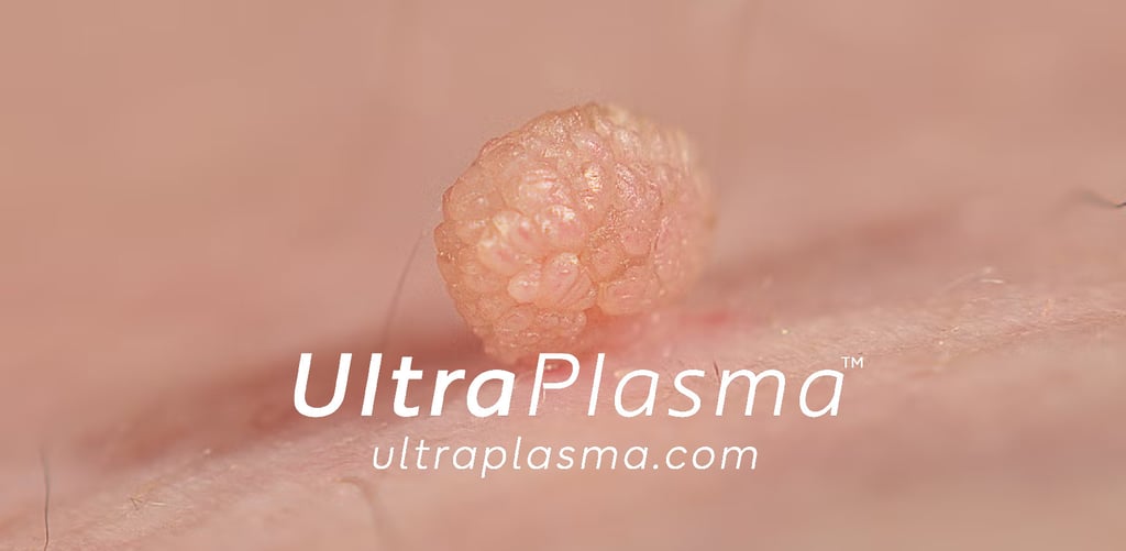 ultraplasma.com_skin_tag_removal_treatment_et_beni_temizleme_silme_tedavi_ultra_plasma_ultra_plazma2