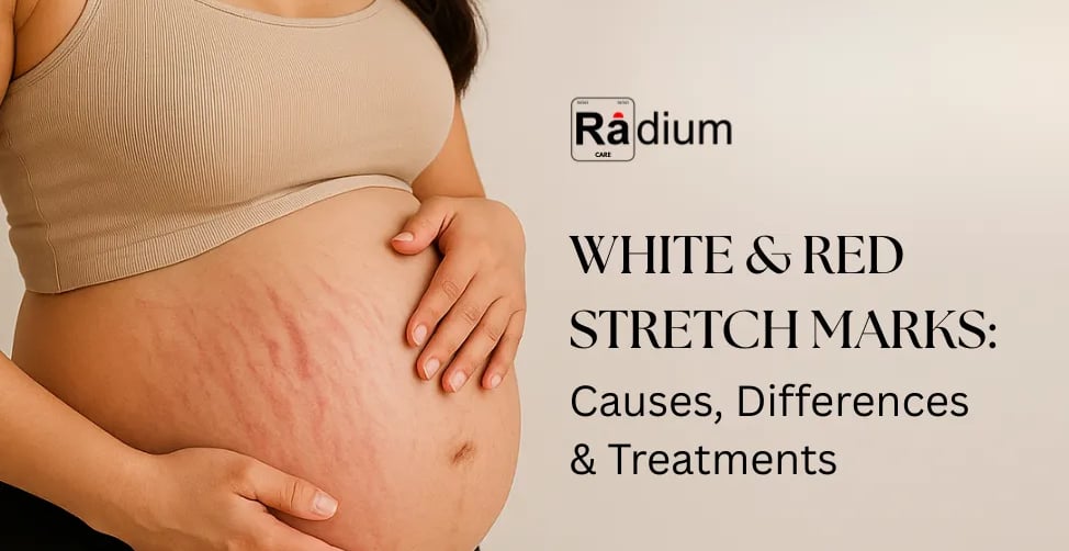 white & red stretch marks