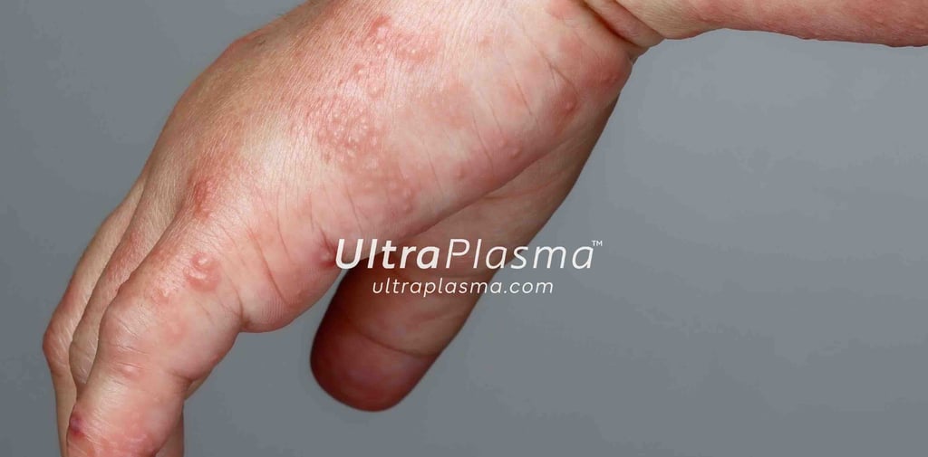 akne_acne_ultra_plasma_ultra_plazma_ultra-plasma_ultra-plazma