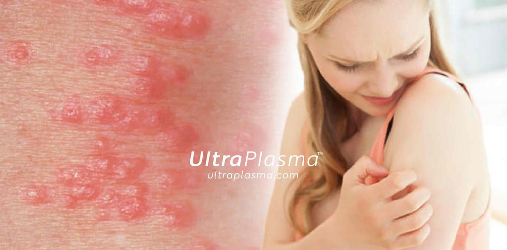 ultraplasma.com_Sarcoptes_scabiei_Infestation_Treatment_ultra_plasma_ultra_plazma