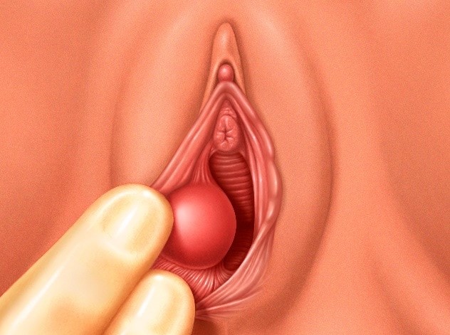 bartholin cysts