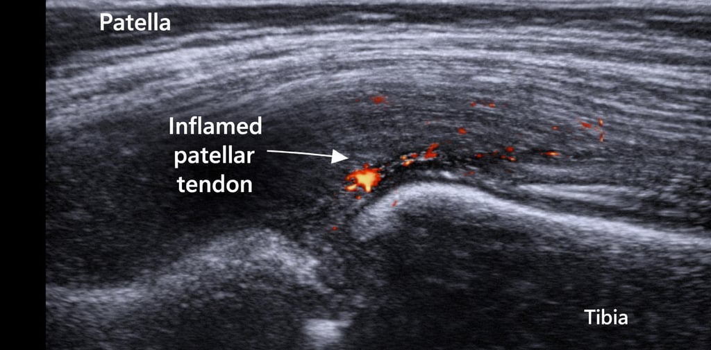echographie tendon genou inflammation