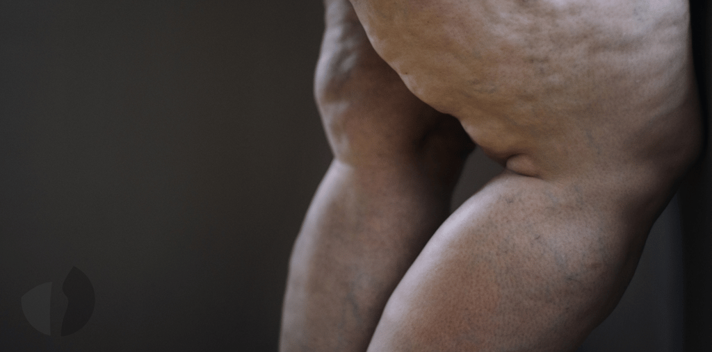 Perna com lipedema