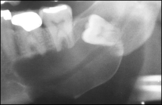 cisto dentígero  resumo patologia oral para concurso público de odontologia patologia bucal