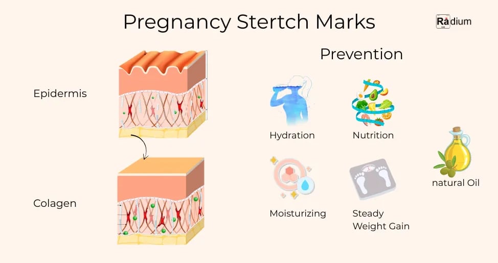 Pregnancy stertch marks