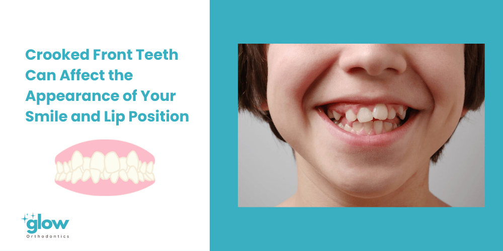 Crooked front teeth can affect the appearance of your smile and lip position