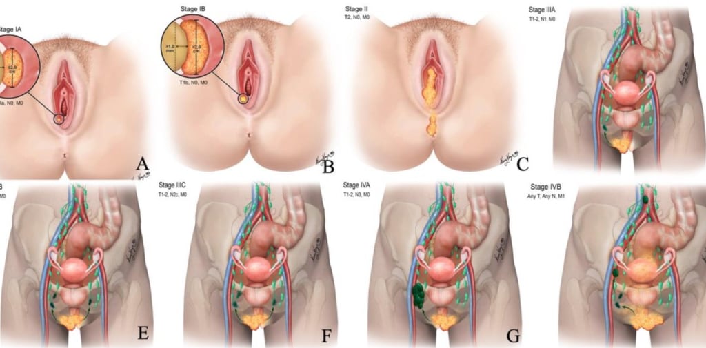 vulvar cancer