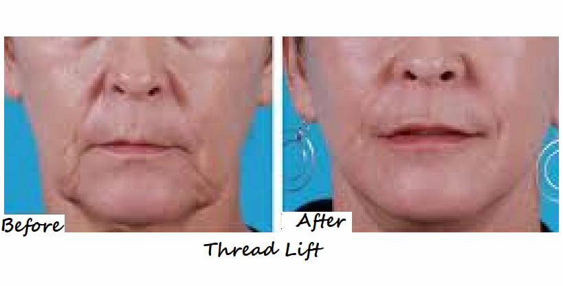 Before and after thread lift in mid and lower face with skin tightening.