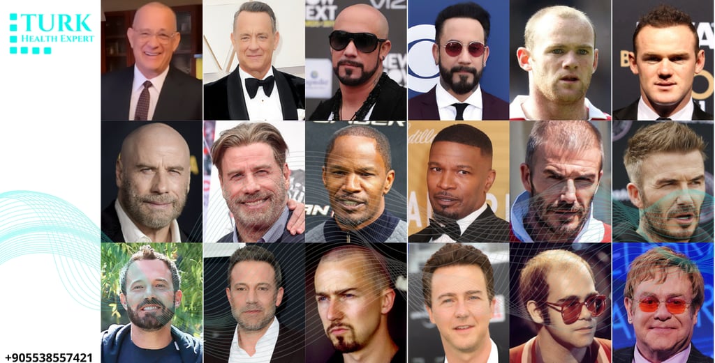Celebrities hair transplants before and after