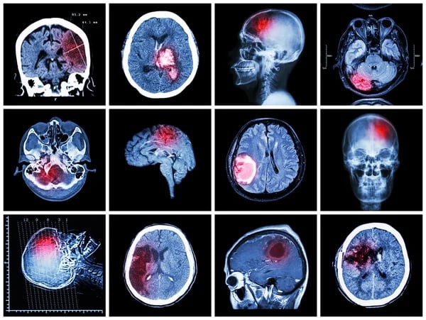 Brain Tumors