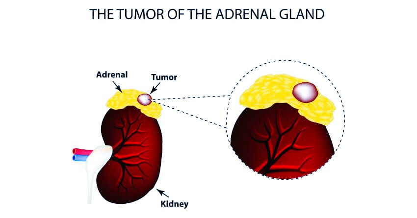 adrenal gland cancer