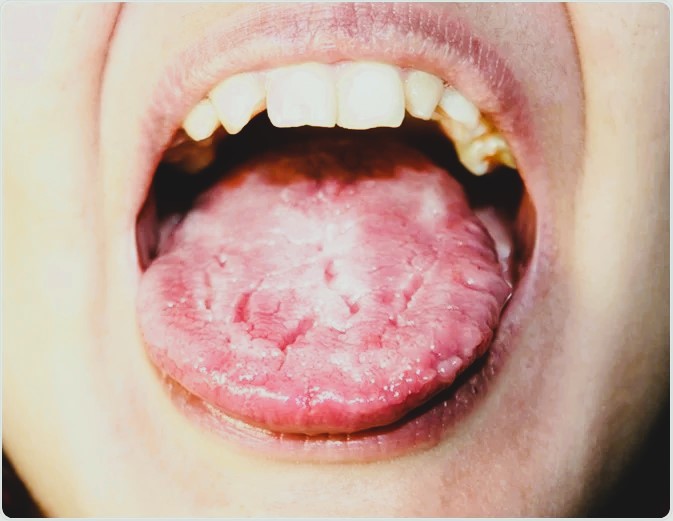 Candidiasis