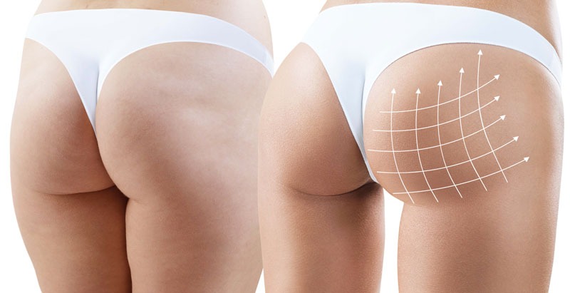 Armonización de glúteos con ácido hialurónico para mejorar volumen y forma