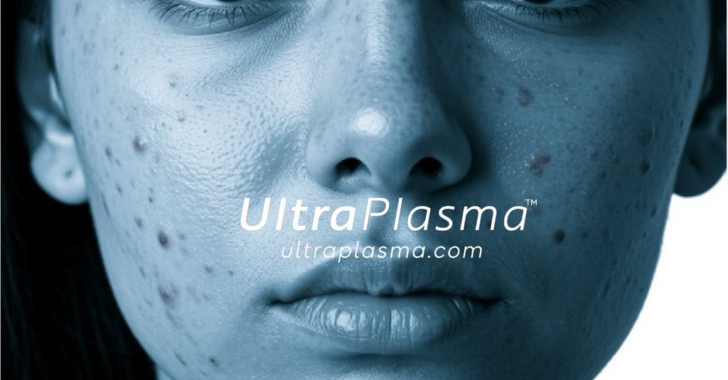 akne_acne_ultra_plasma_ultra_plazma_ultra-plasma_ultra-plazma