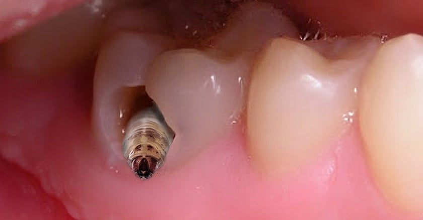 sâu răng