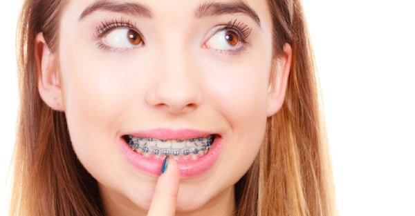 niềng răng bao lâu