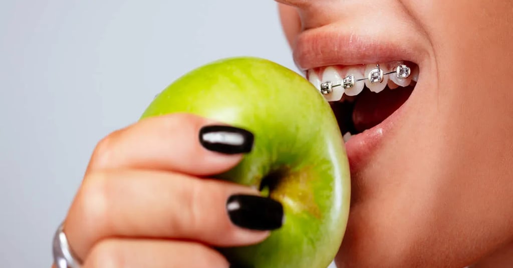 Chăm sóc răng sau khi niềng