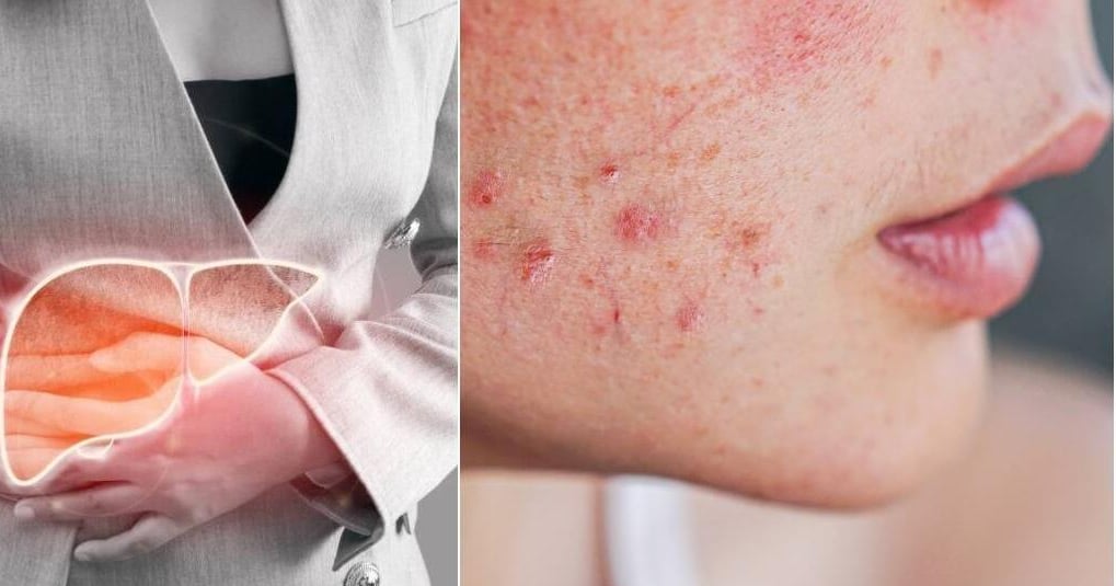 Señales de Hígado Graso en la Piel: Lo que tu Cuerpo te Está Diciendo