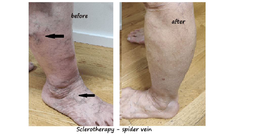 Legs with spider veins before and 6 weeks after sclerotherapy – clear reduction of spider veins.