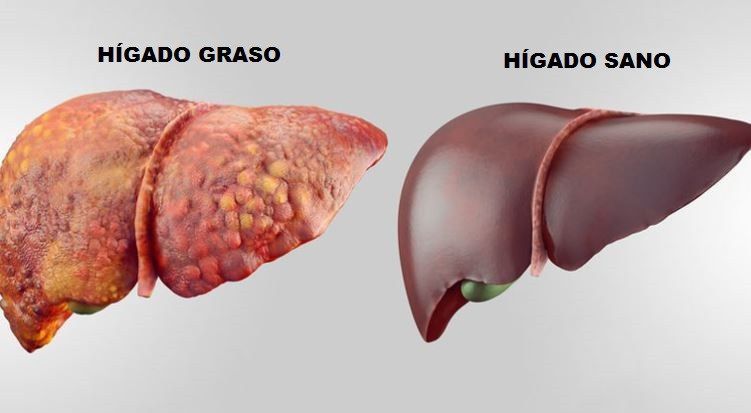 Dieta para Hígado Graso: La Guía Definitiva para Revertir la Esteatosis Hepática