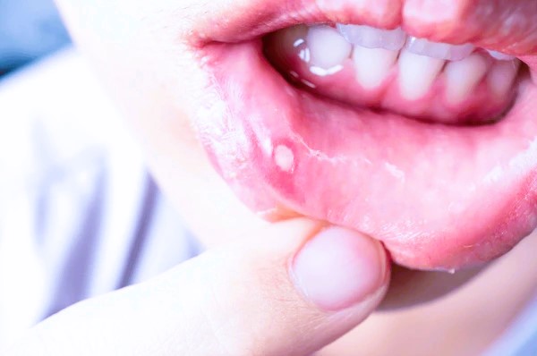 Canker sores
