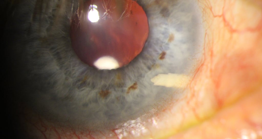 Alloflo scleral implant