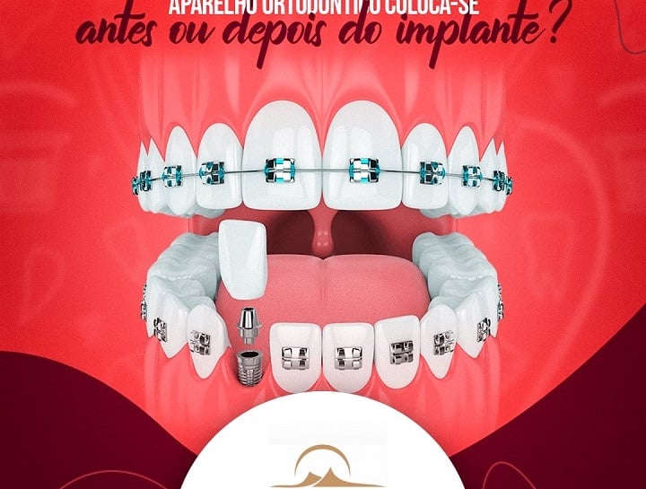 Dentista Ortodontista Recreio dos Bandeirantes Perto de mim Implante Aparelho Dentário