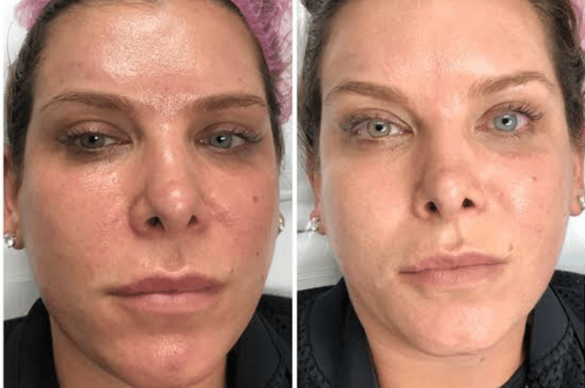 antes y despues de tratamiento facil en mujer