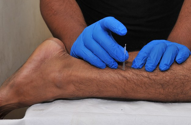 Dry needling and pain treatment in Noida, Delhi, Ghaziabad, Greater Noida