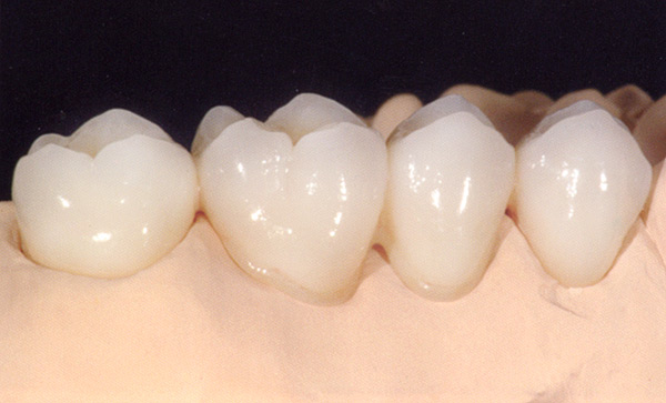 Corona de zirconia en molar