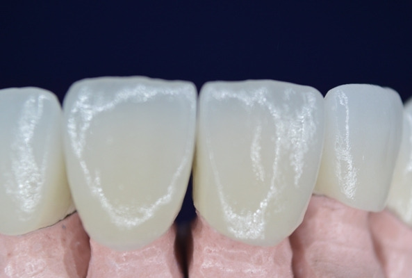 Coronas de zirconia dientes centrales