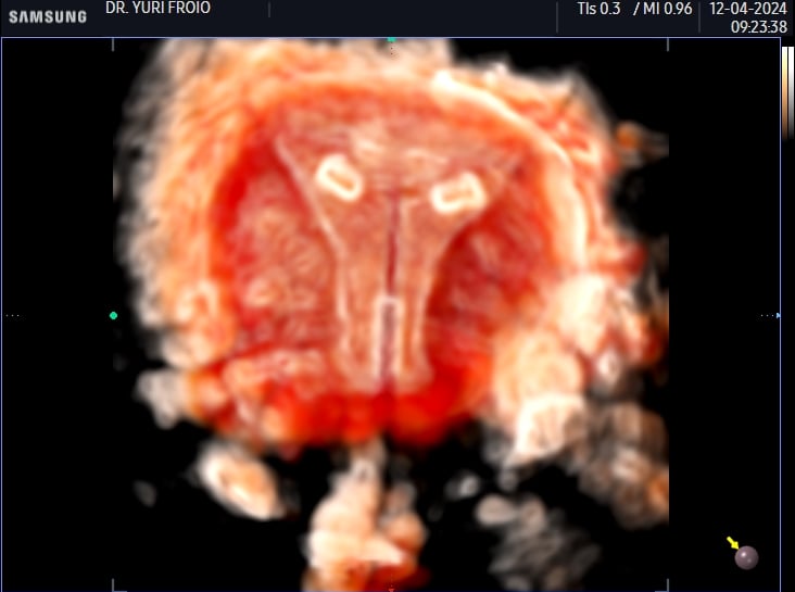 DIU bem posicionado no 3D