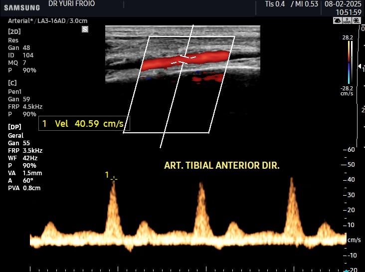 Artéria tibial anterior com fluxo normal ao Doppler