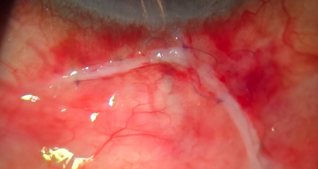 Ahmed shunt wount 7x7mm