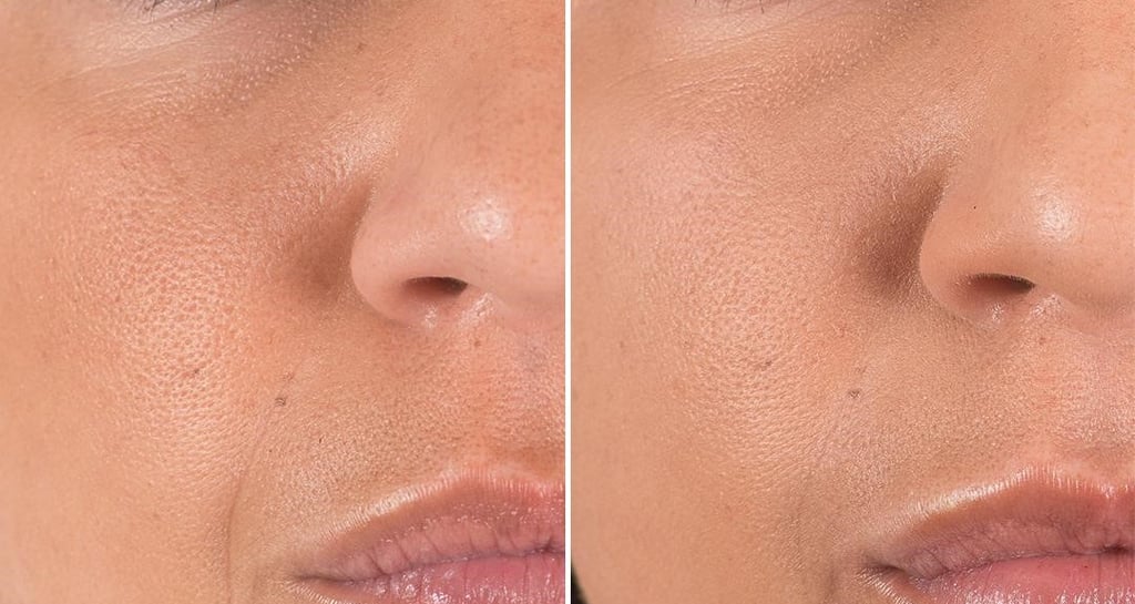 dermal filler results