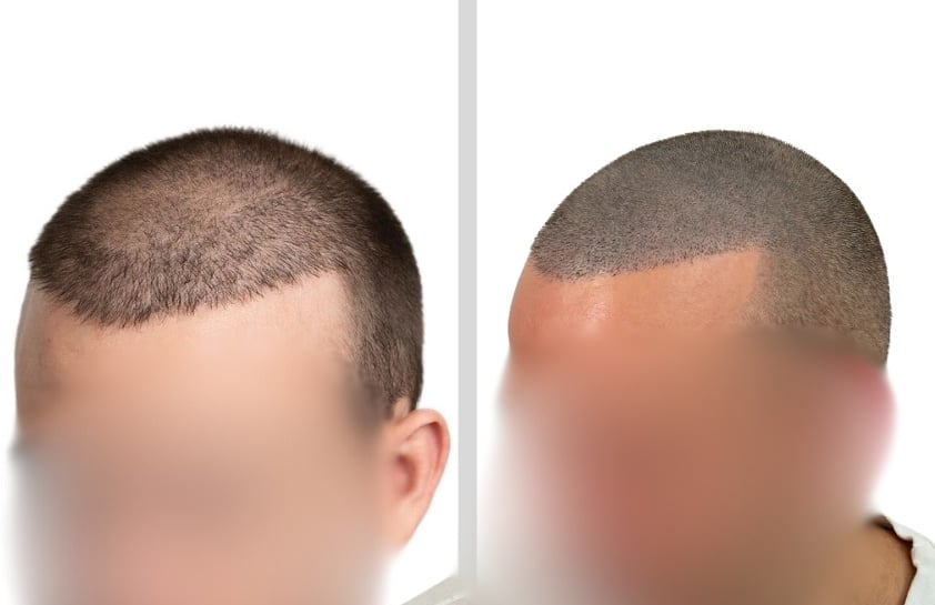 Tricopigmentation Avant Après Calvitie Perte de Densité Capillaire Homme