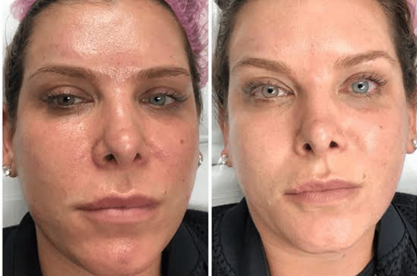 antes y despues de tratamiento facil en mujer