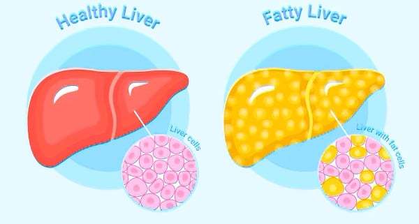 fatty liver
